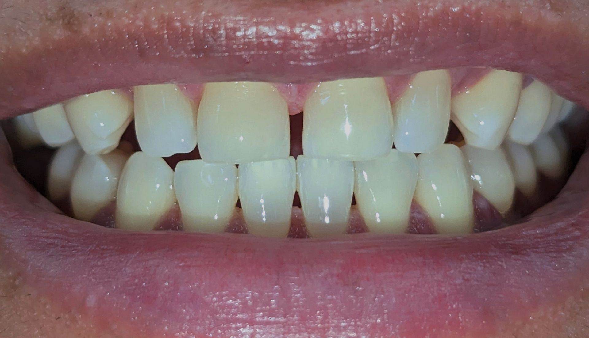 A close up of a person 's mouth with white teeth.