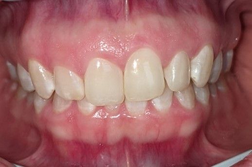 A close up of a person 's teeth with white teeth.