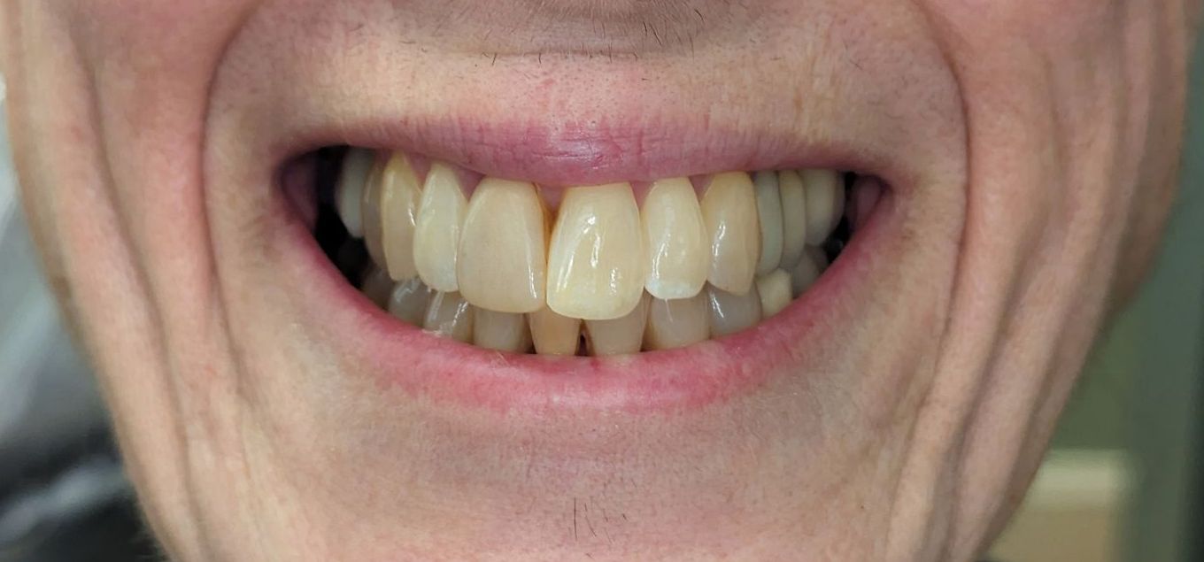A close up of a man 's teeth with a smile on his face.