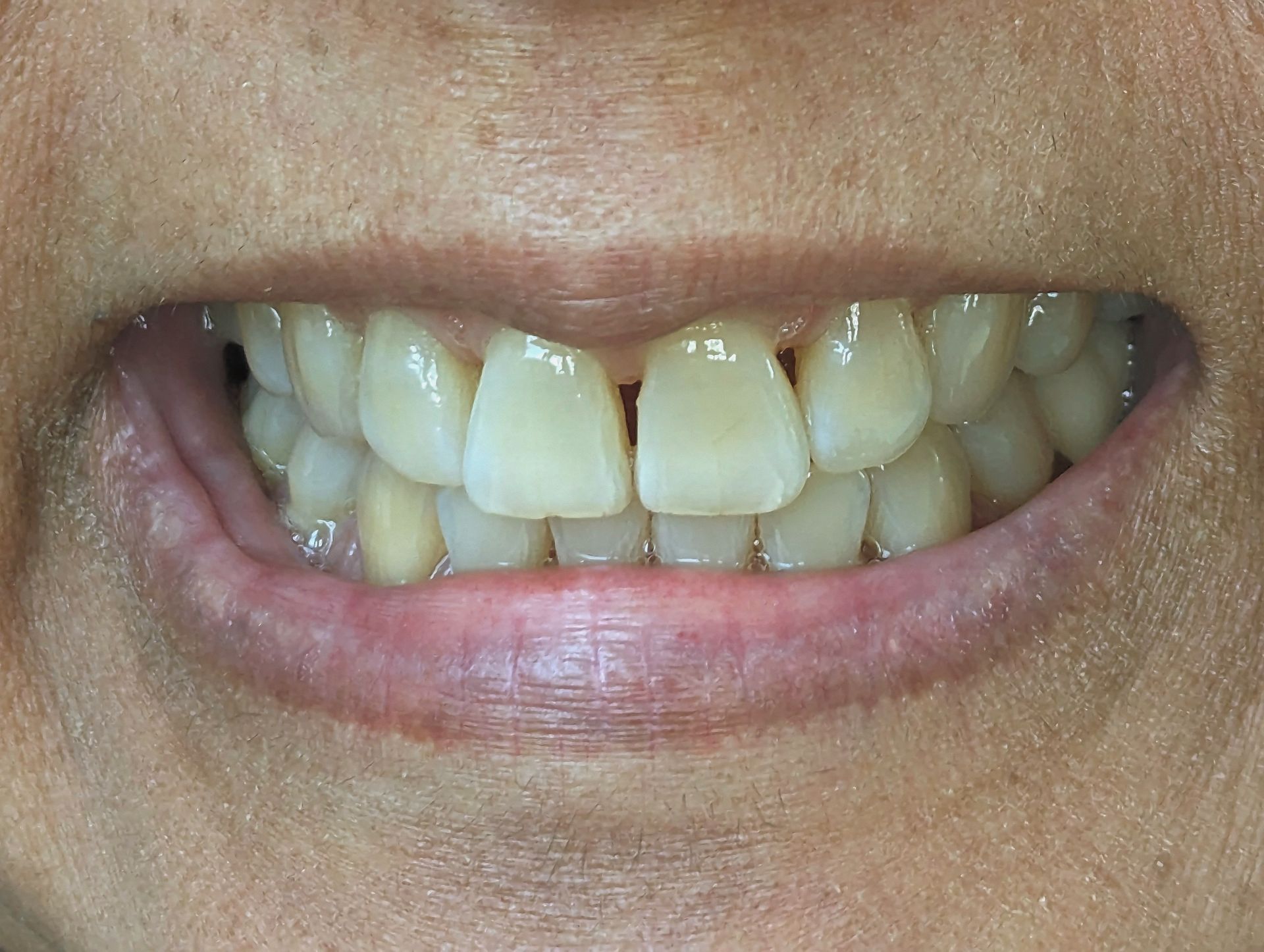 A close up of a person 's mouth with white teeth.