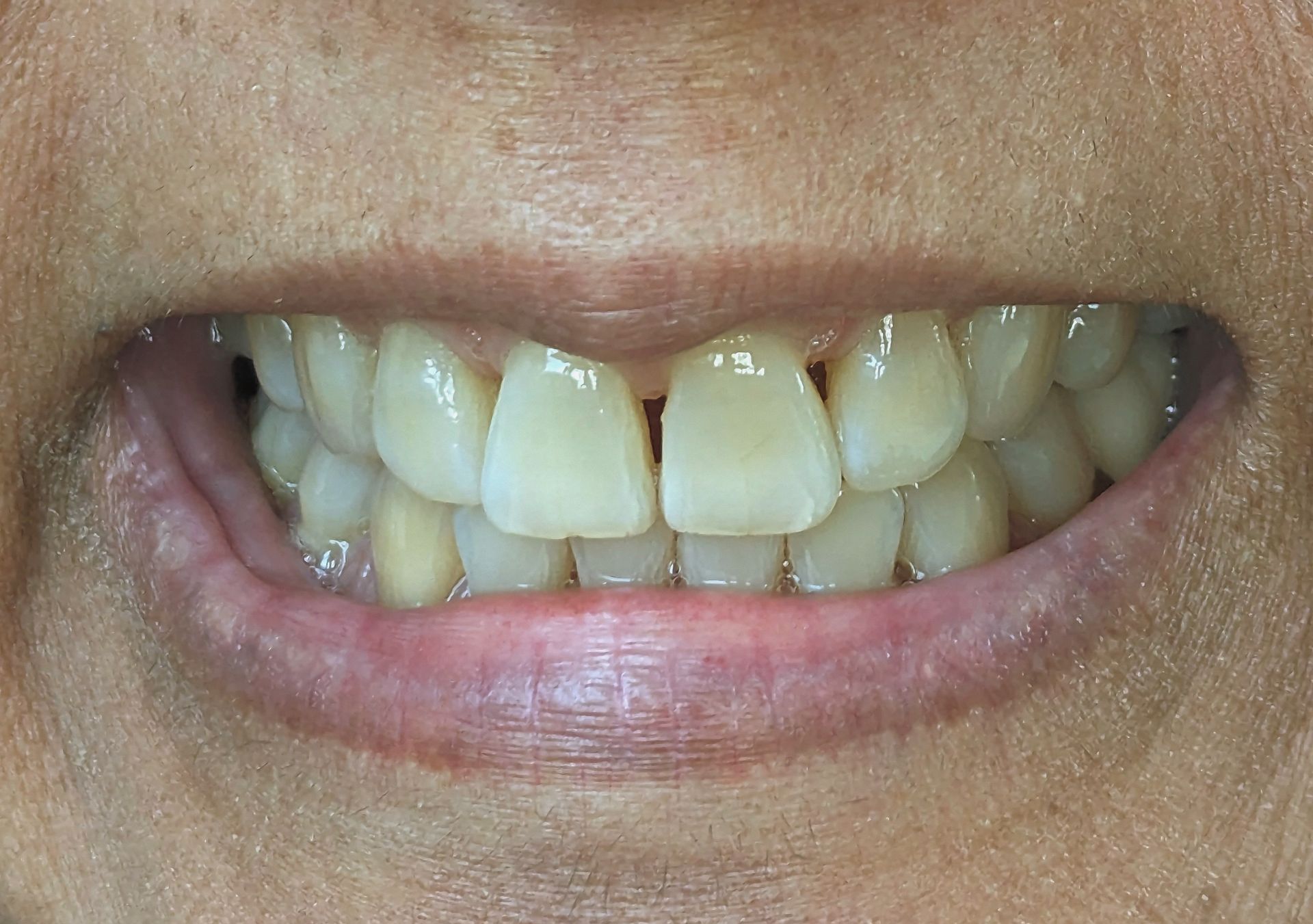 A close up of a person 's mouth with white teeth.