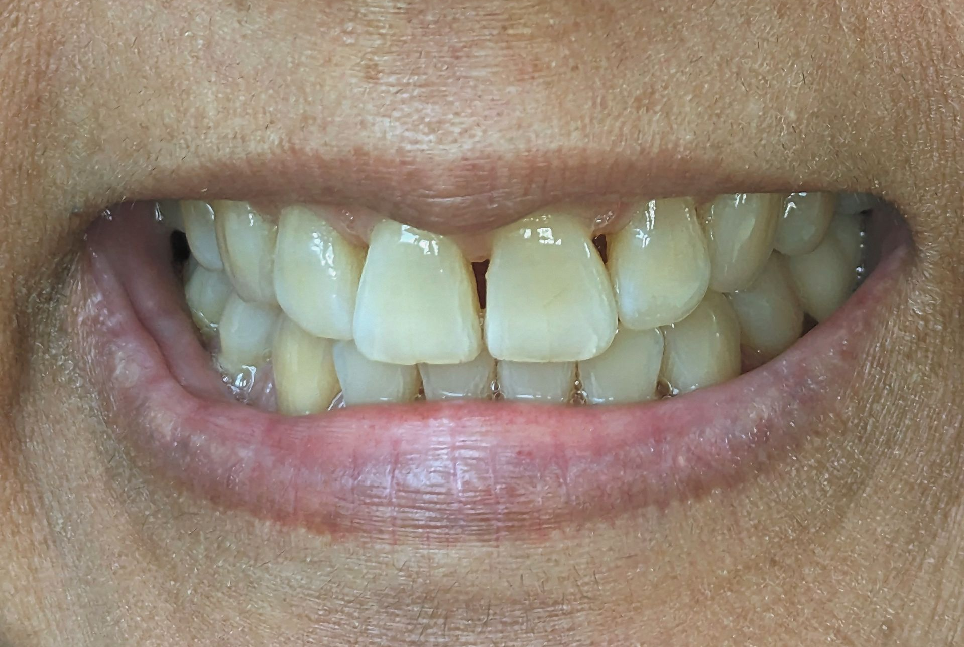 A close up of a person 's mouth with white teeth.
