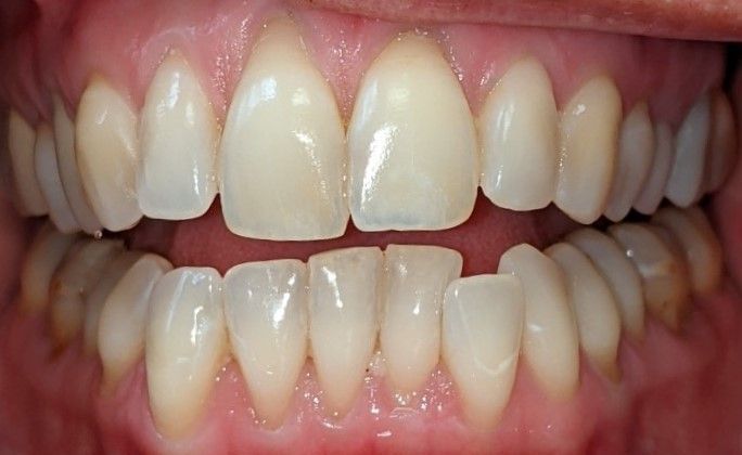 A close up of a person 's teeth with a missing tooth.
