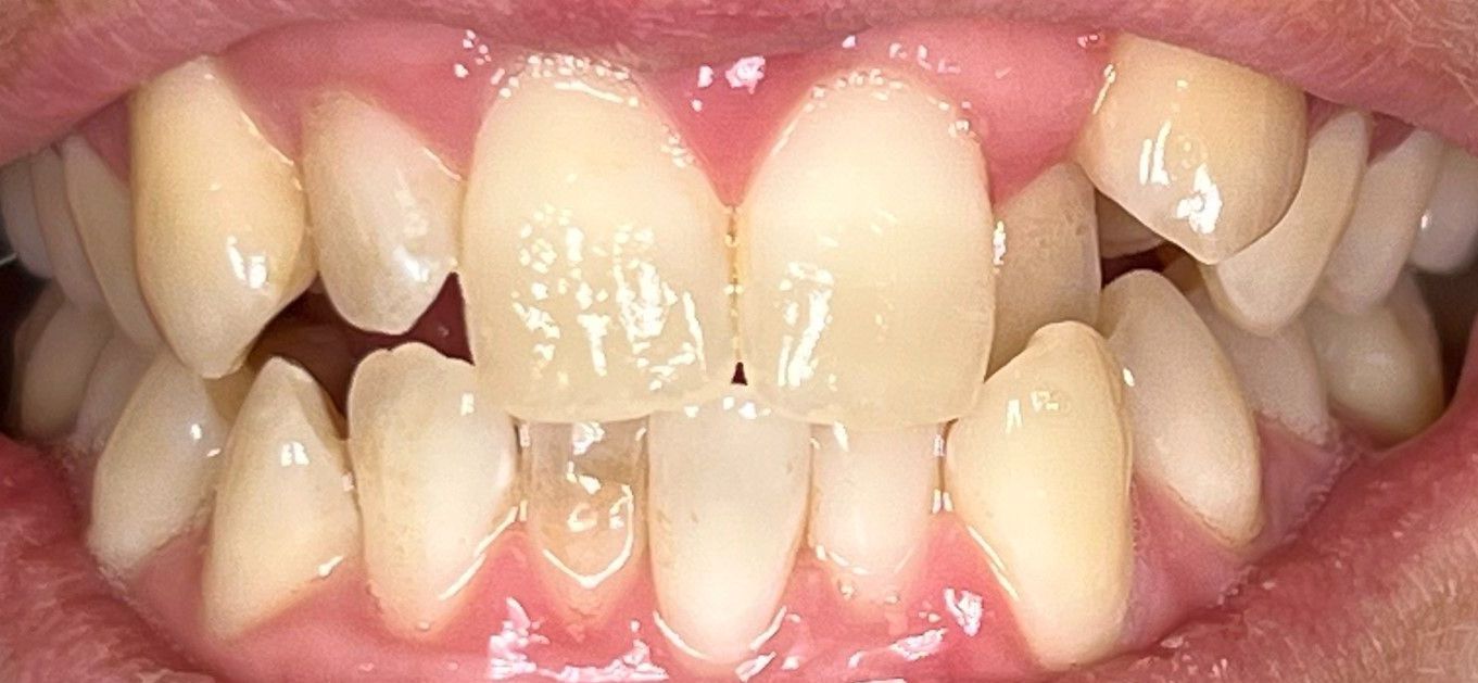 A close up of a person 's teeth with a hole in the middle.