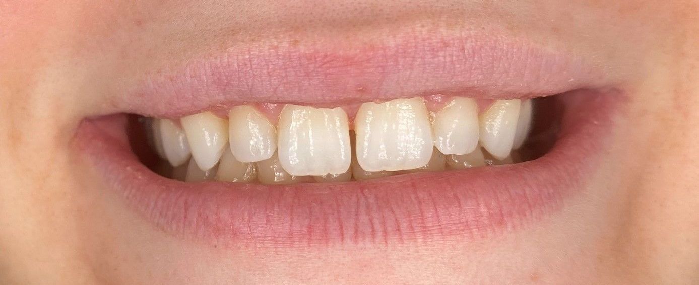 A close up of a person 's mouth with white teeth.