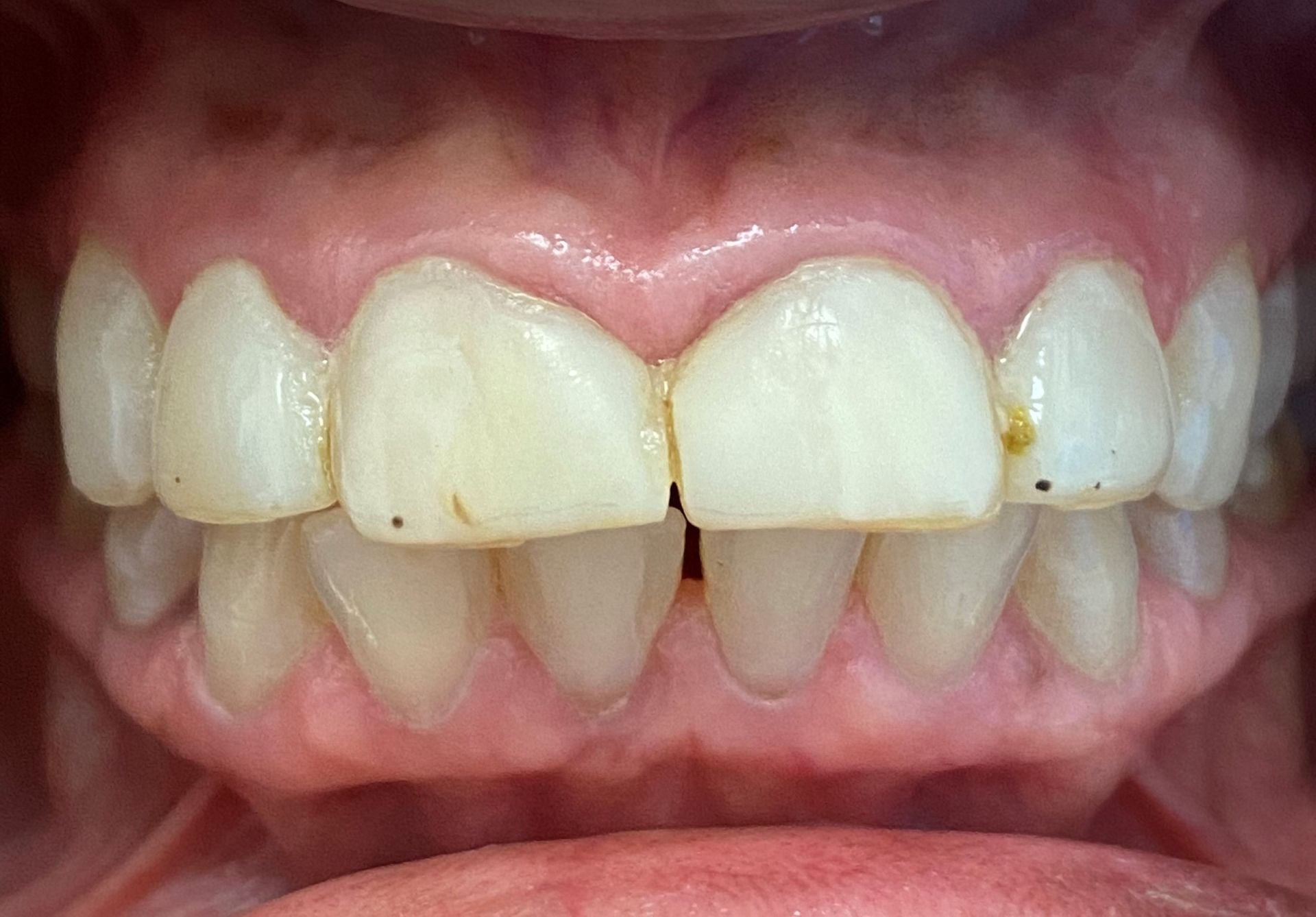 A close up of a person 's teeth with white teeth.