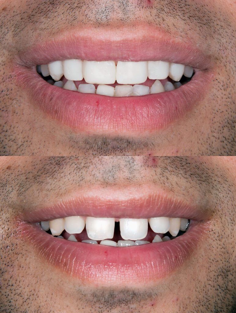 A before and after picture of a man 's teeth