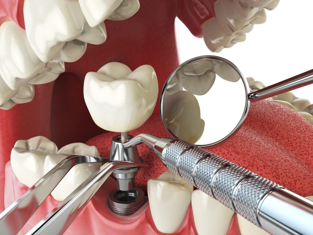A dental implant is being placed in a person 's teeth.
