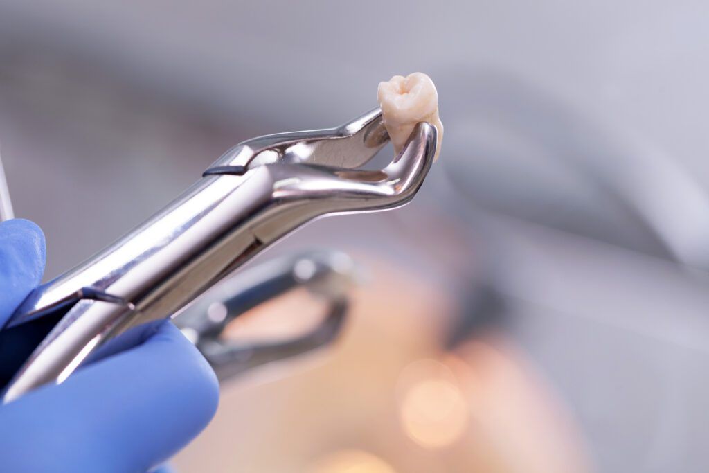 A dentist is holding a pair of pliers with a tooth in it.