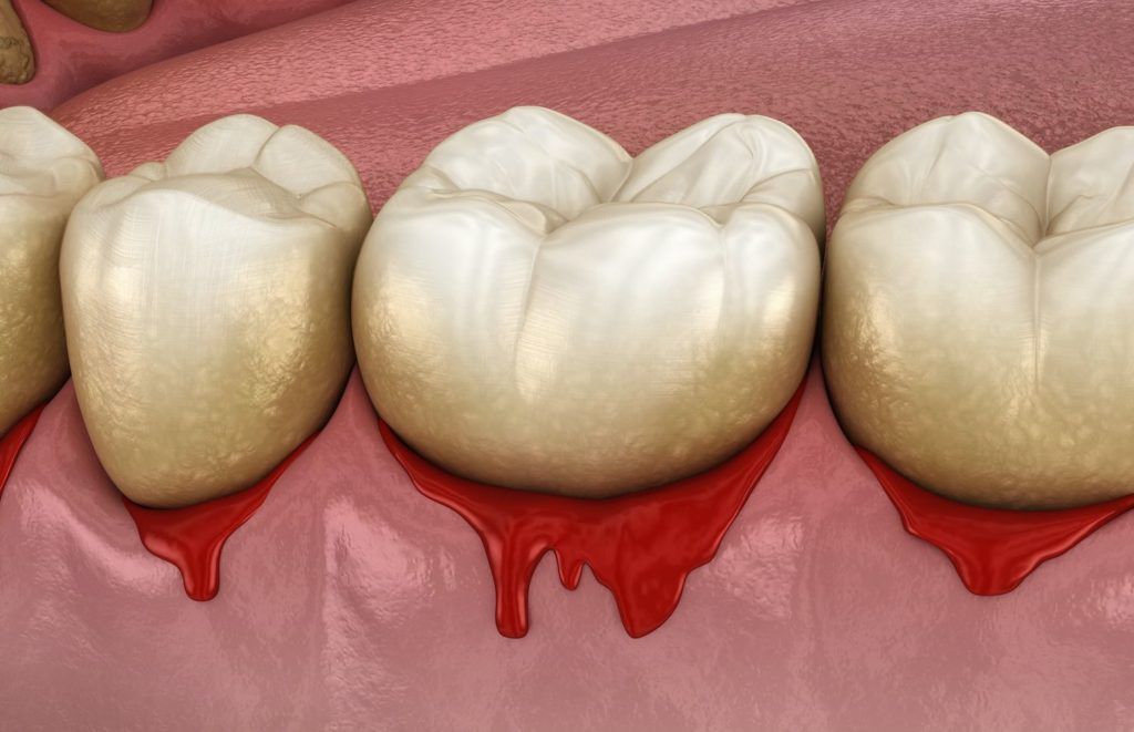 A close up of a row of teeth with red gums.