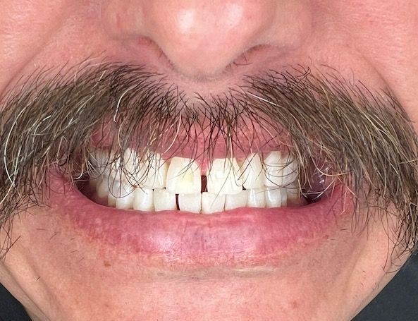 A close up of a man 's mouth with a mustache and teeth.