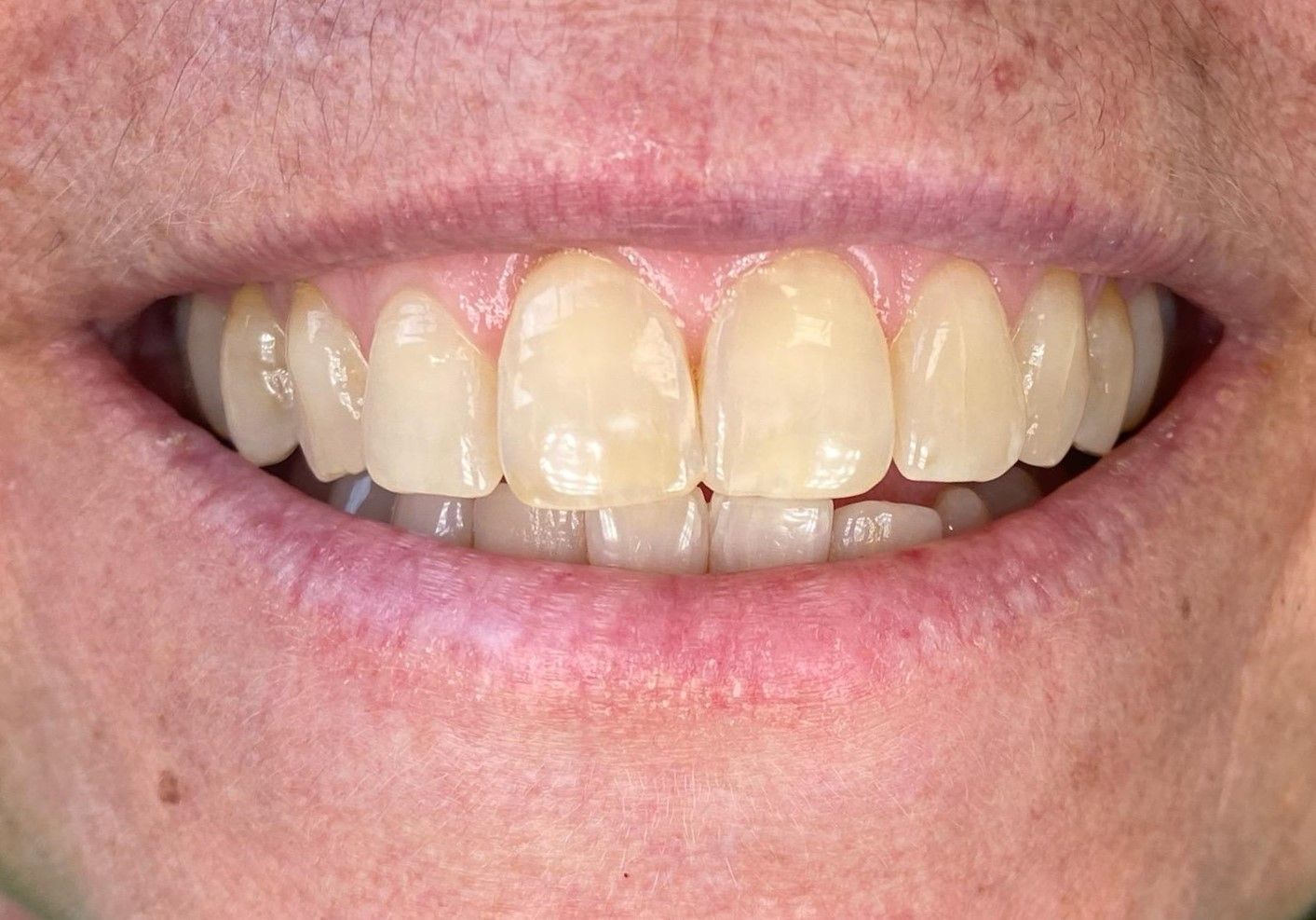 A close up of a person 's smile with white teeth.