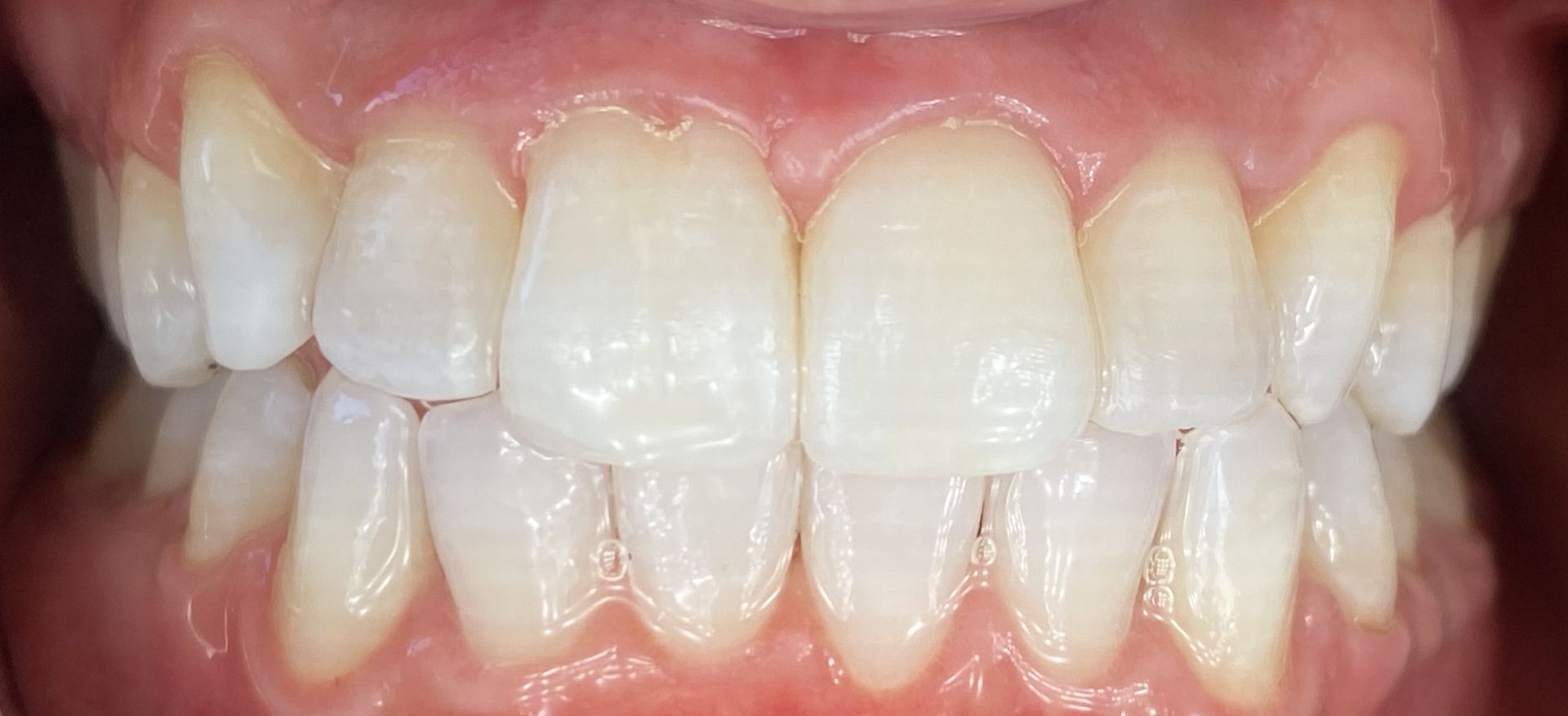 A close up of a person 's teeth with white teeth.