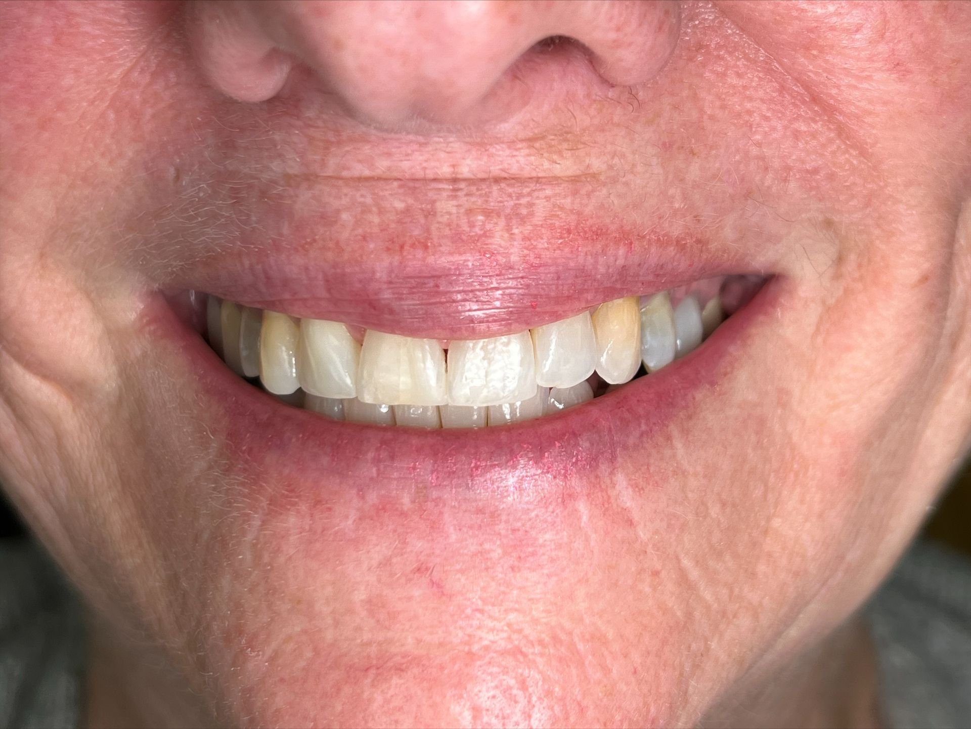 A close up of a woman 's smile with white teeth.