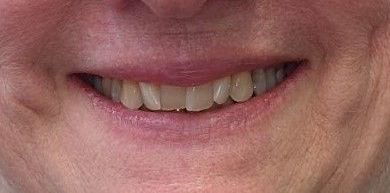 A close up of a woman 's smile with a missing tooth.