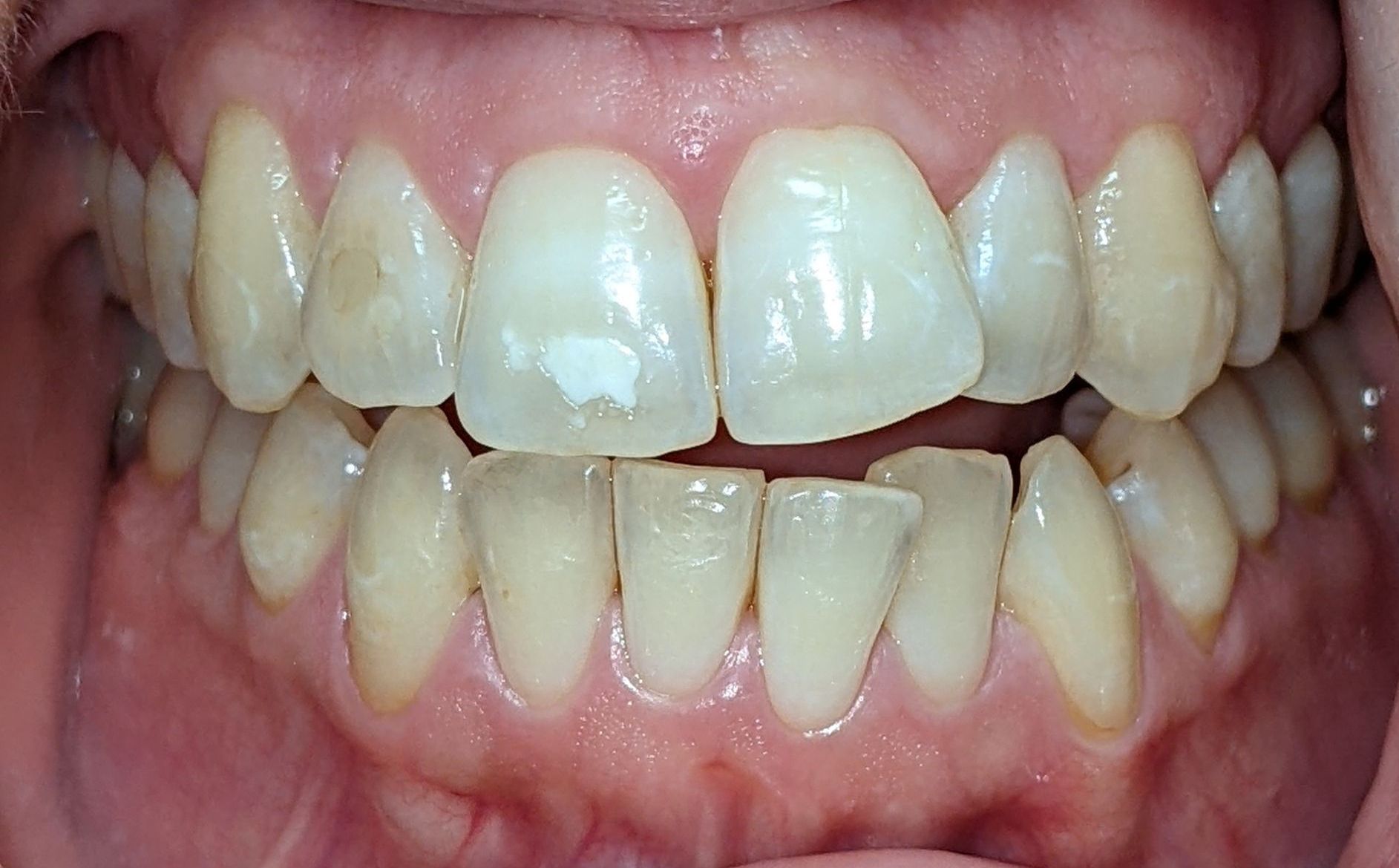 A close up of a person 's teeth with a lot of white teeth.