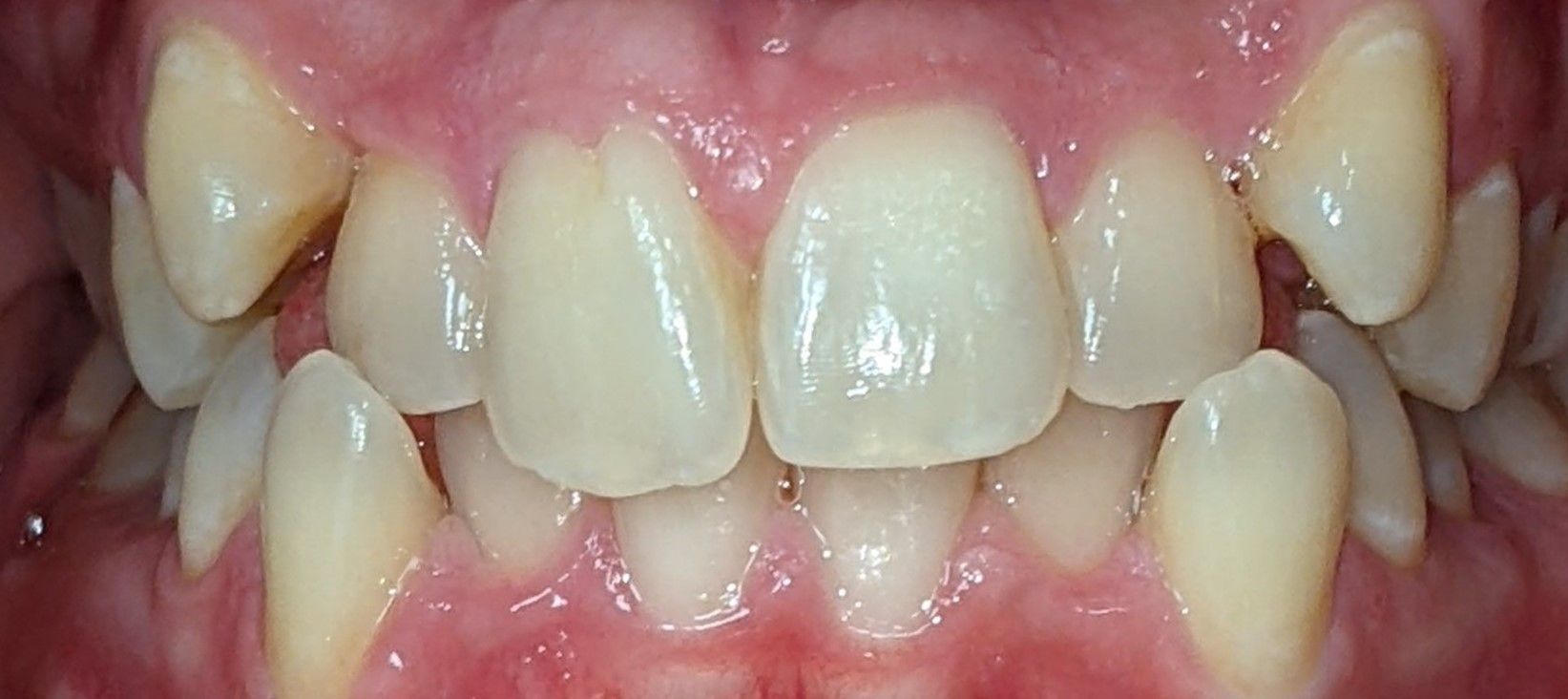 A close up of a person 's teeth and gums.