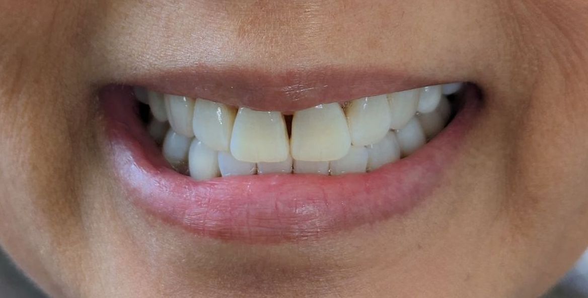 A close up of a woman 's smile with white teeth.