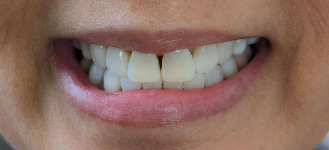 A close up of a person 's mouth with white teeth.