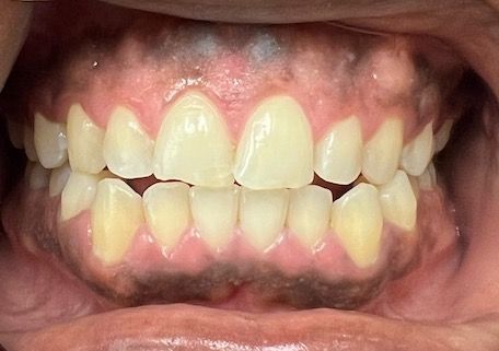 A close up of a person 's teeth and mouth.