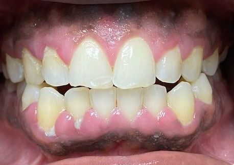 A close up of a person 's teeth and gums.