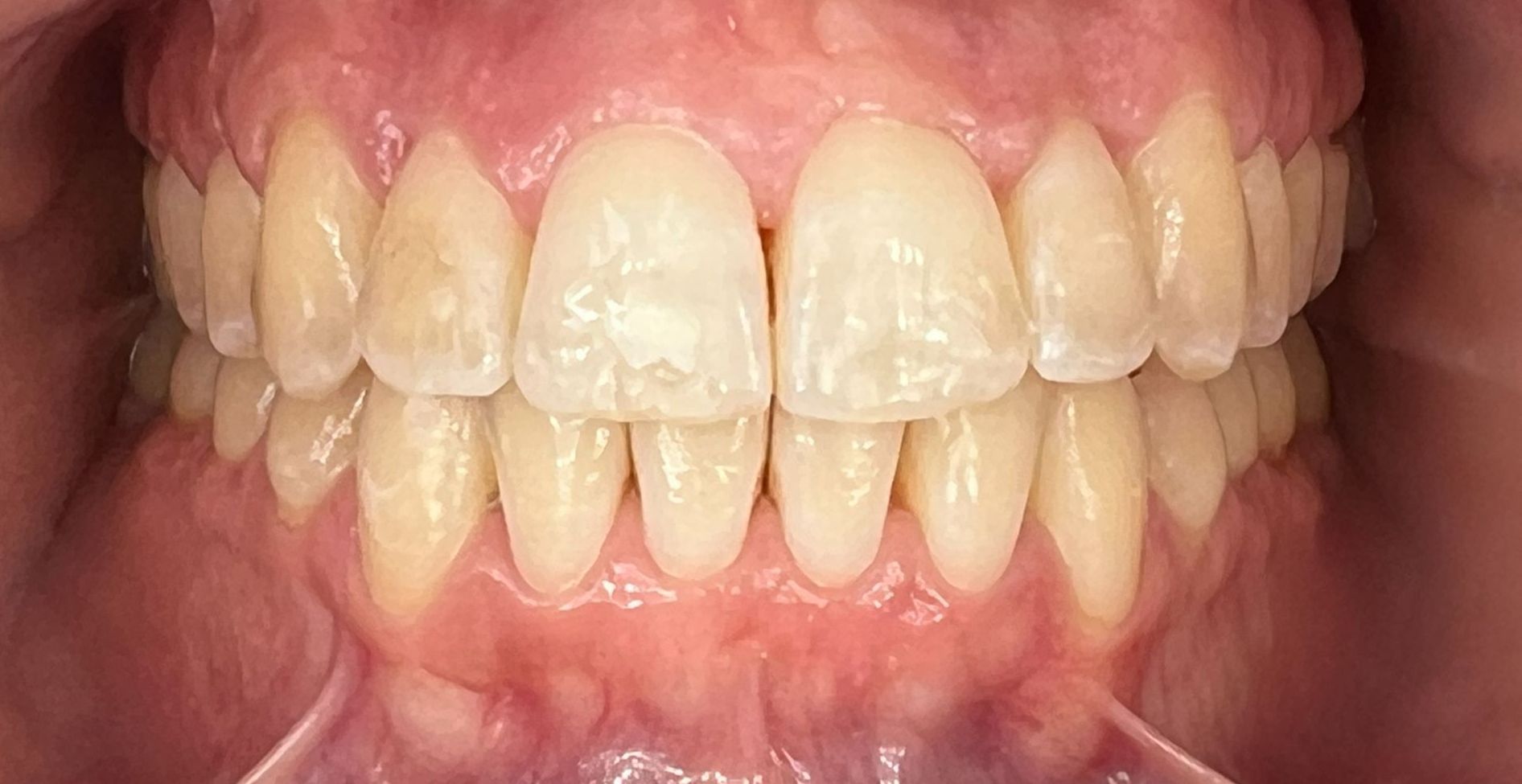 A close up of a person 's teeth and gums.