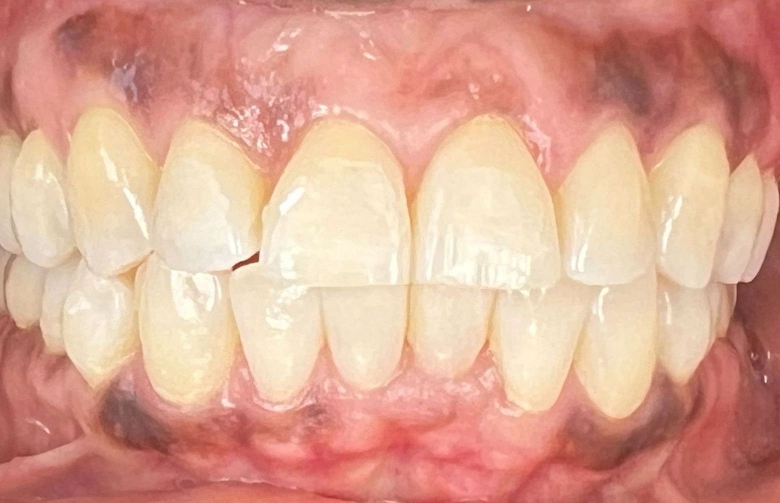 A close up of a person 's teeth with a broken tooth.