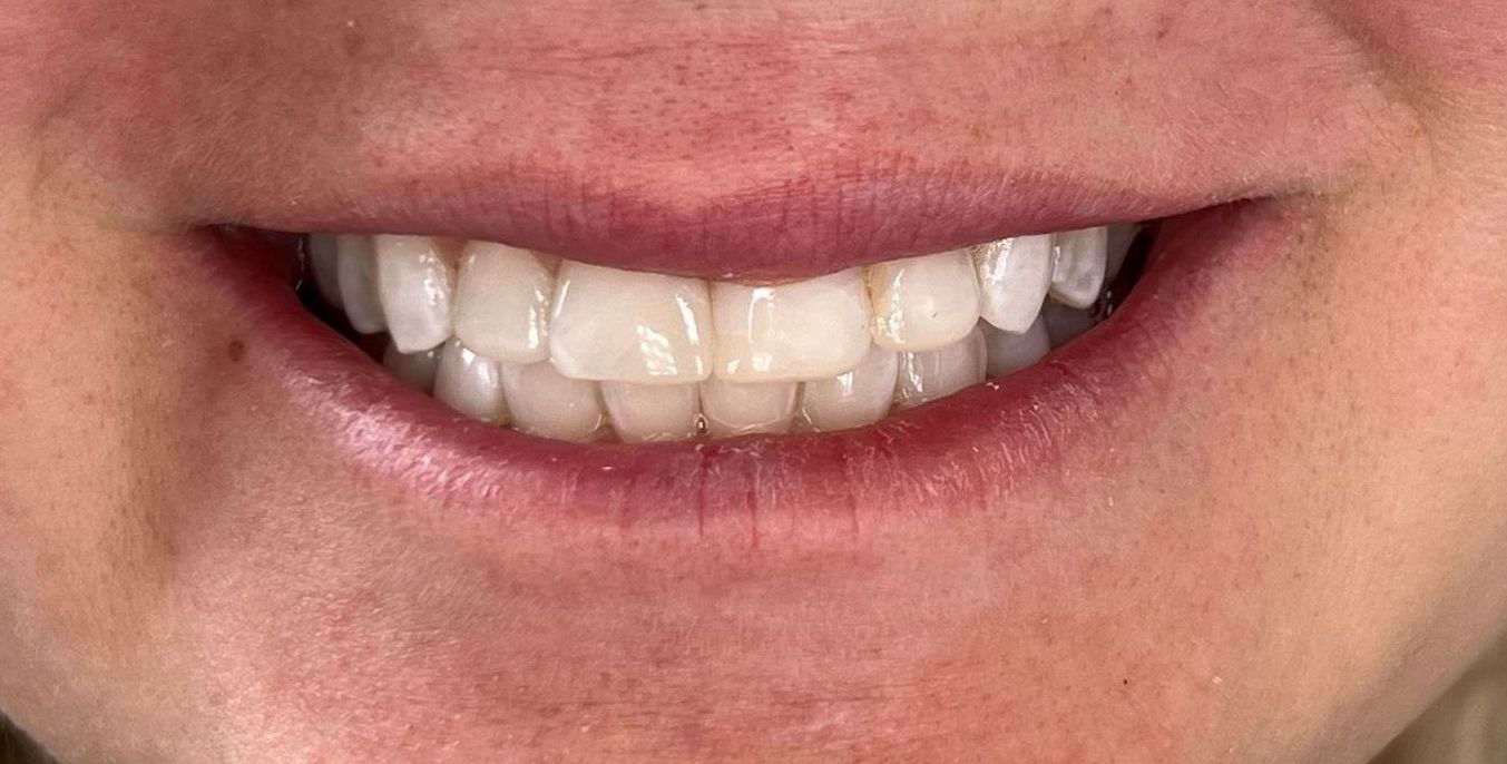 A close up of a woman 's smile with white teeth.