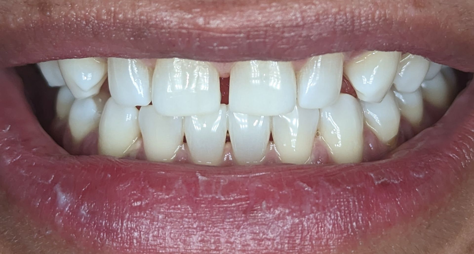 A close up of a person 's mouth with white teeth.