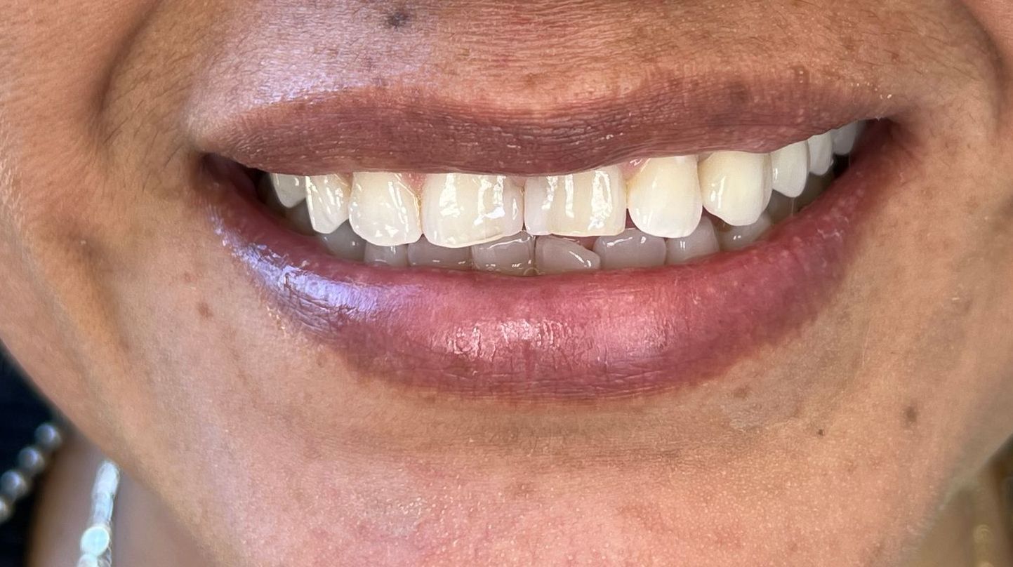 A close up of a woman 's smile with white teeth.