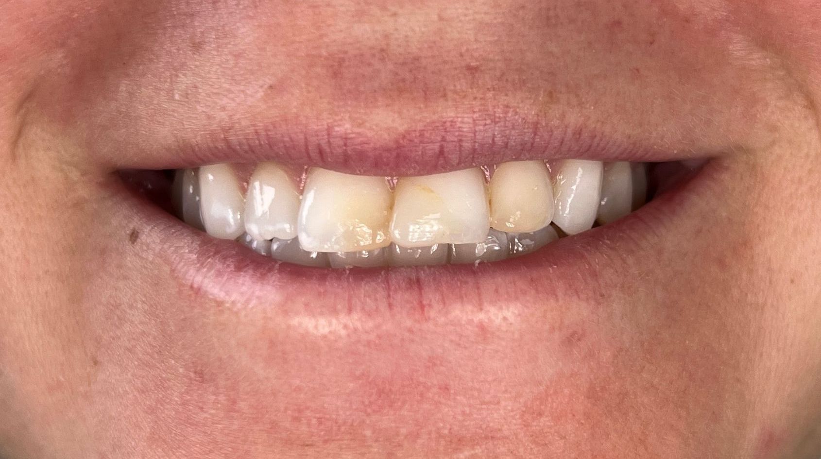 A close up of a person 's teeth with a smile on their face.