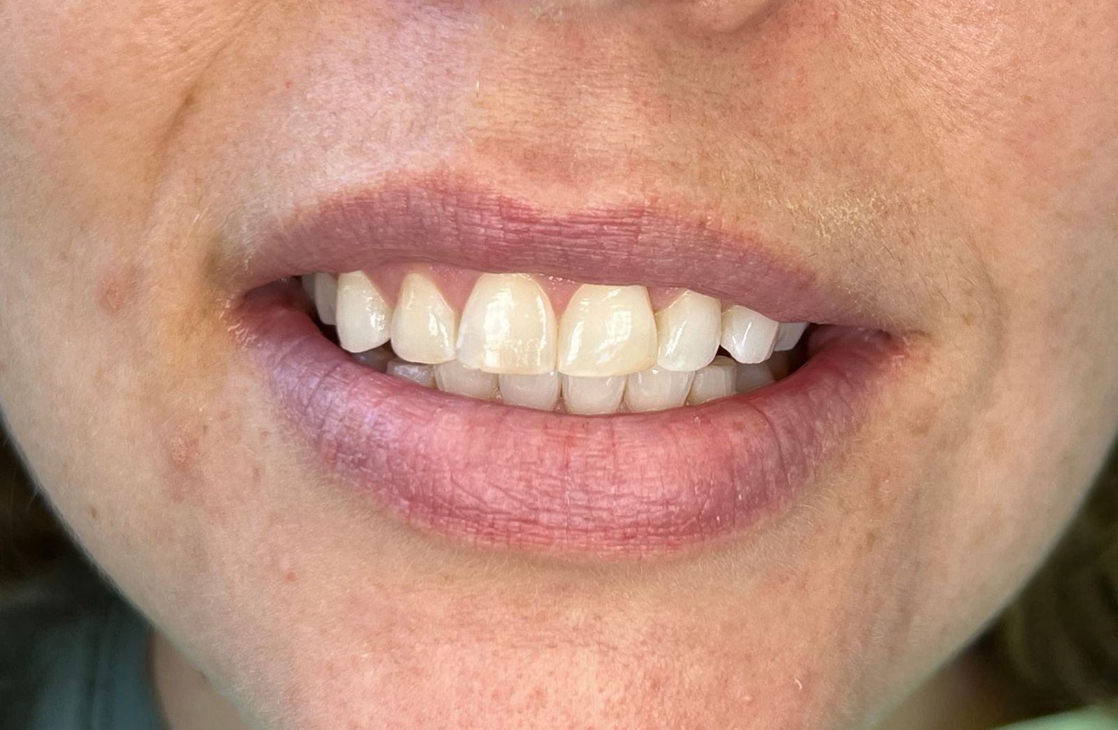 A close up of a woman 's mouth with white teeth.