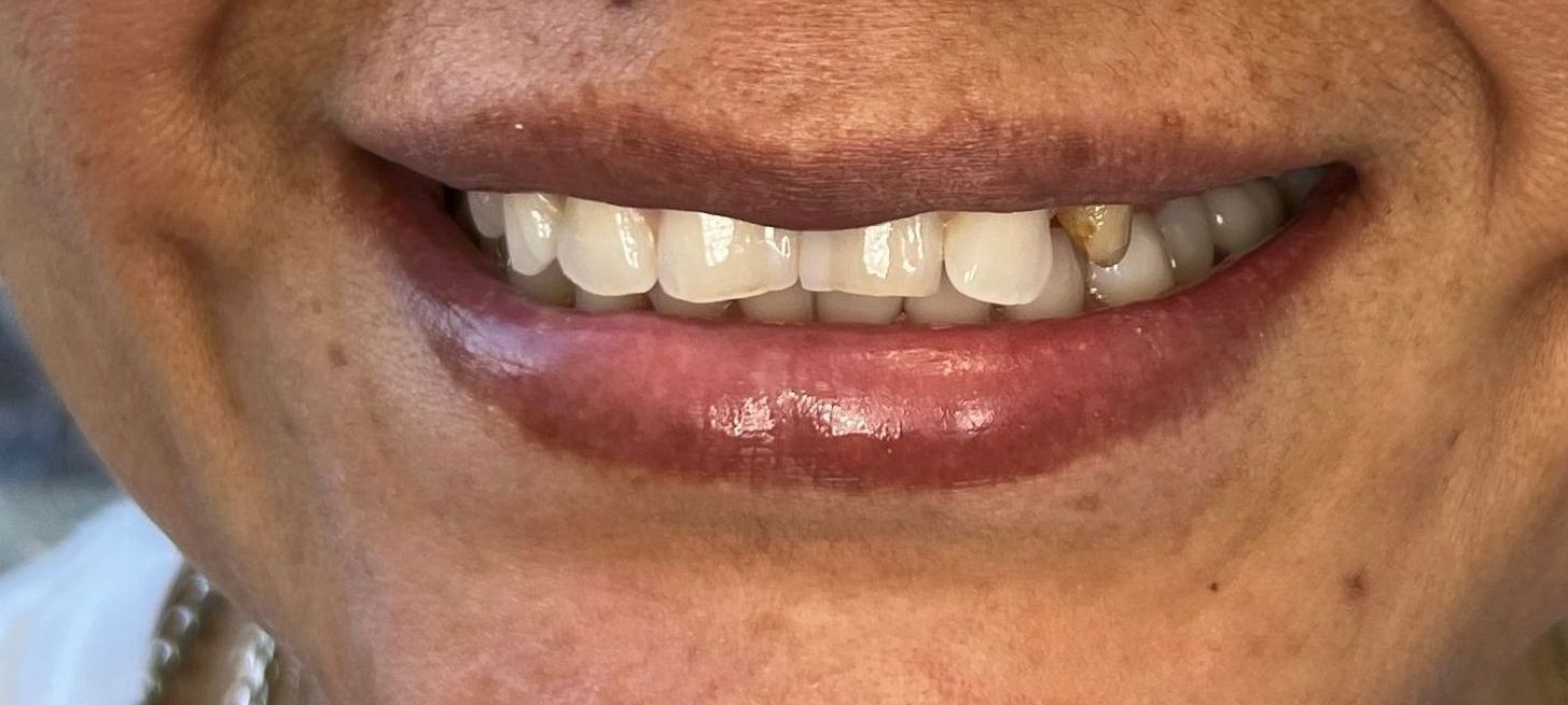 A close up of a woman 's smile with missing teeth.