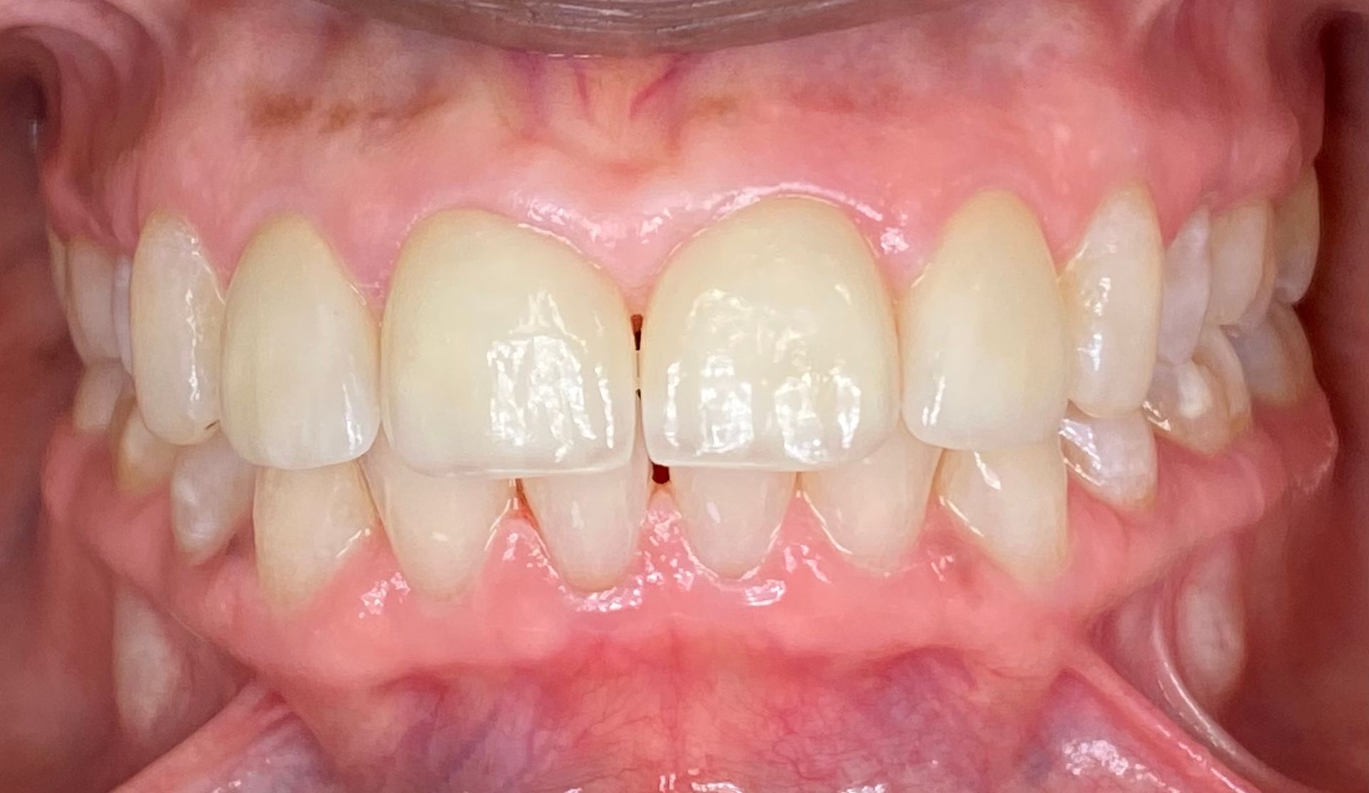 A close up of a person 's teeth and mouth.