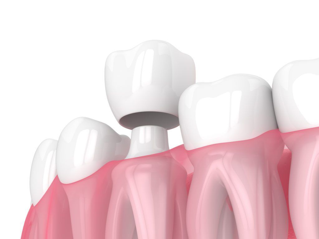 A computer generated image of a tooth with a crown on it.