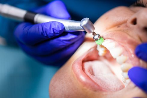 Dentista che usa un trapano per pulire i denti di un paziente. Primo piano della bocca aperta e della mano guantata con lo strumento odontoiatrico.