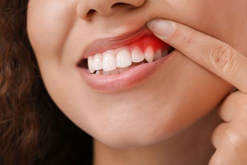Donna che indica gengive rosse e infiammate, segno di un possibile problema dentale.