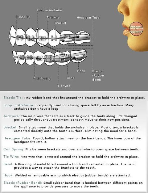 Orthodontic Braces Diagram | James W. May DDS, PC