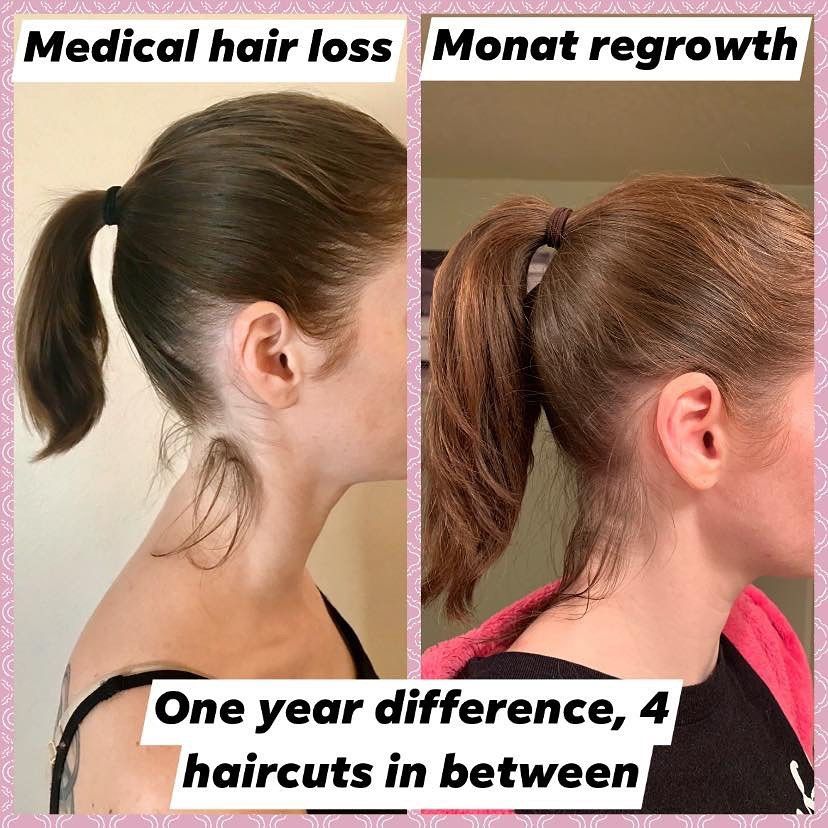 hair-loss-before-after