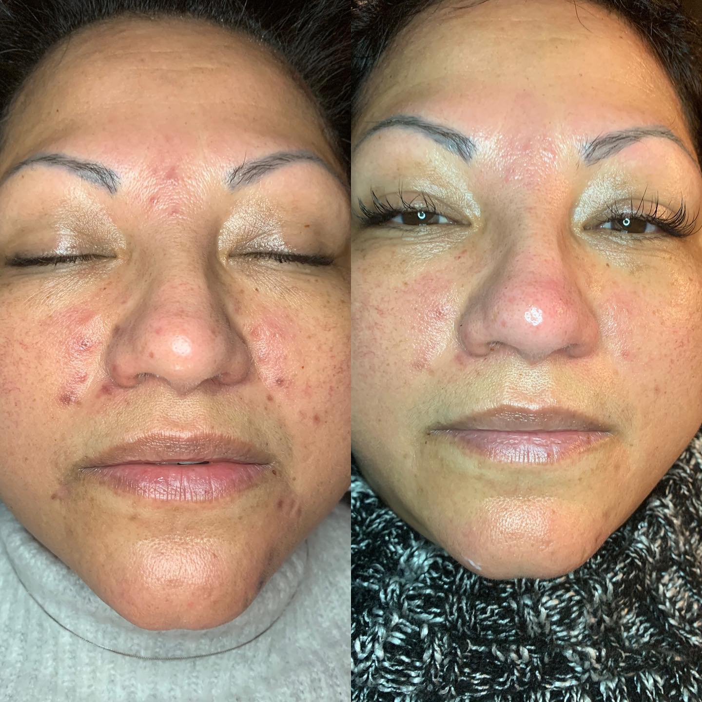 facial before-after