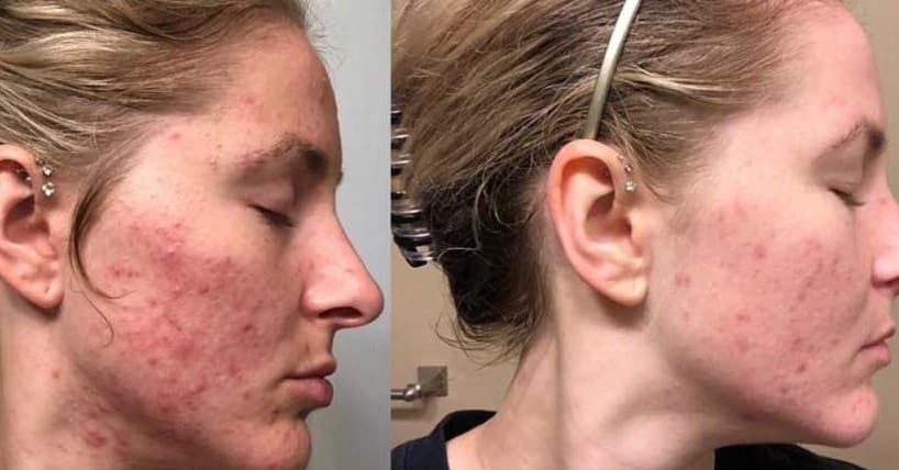skincare before-after