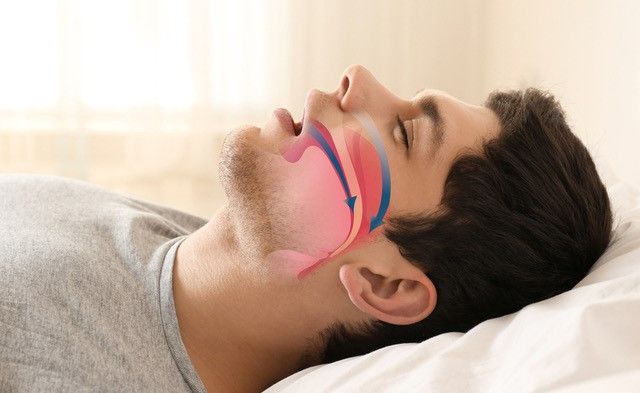 trattamento delle apnee notturne