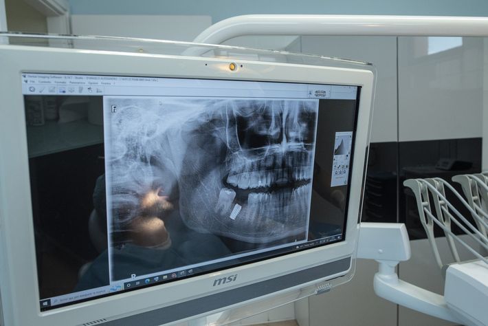 interventi endodontici