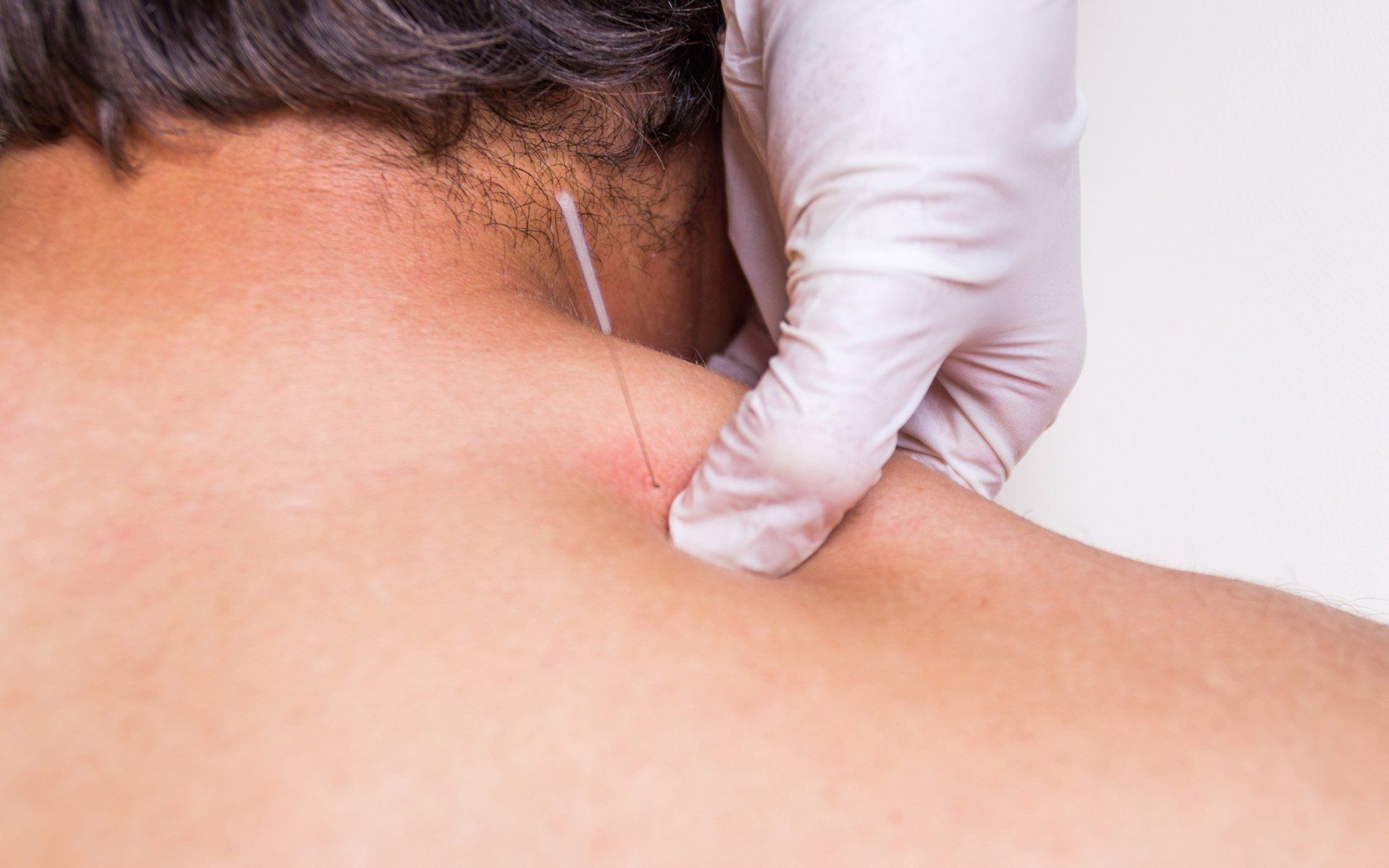 Dry Needling — Florence, KY — Broeg Chiropractic And Nutrition Center