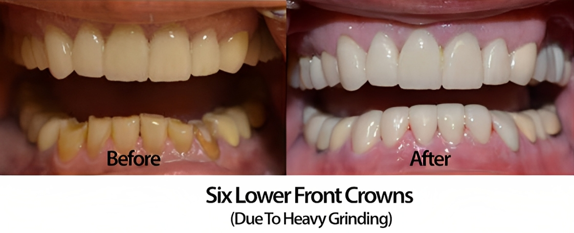 front crowns