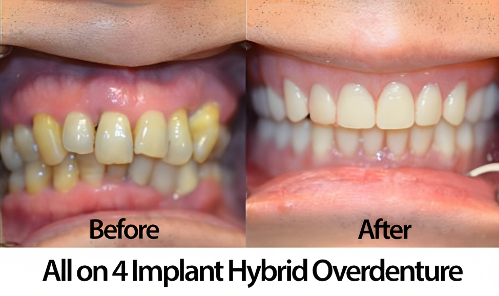 implant hybrid