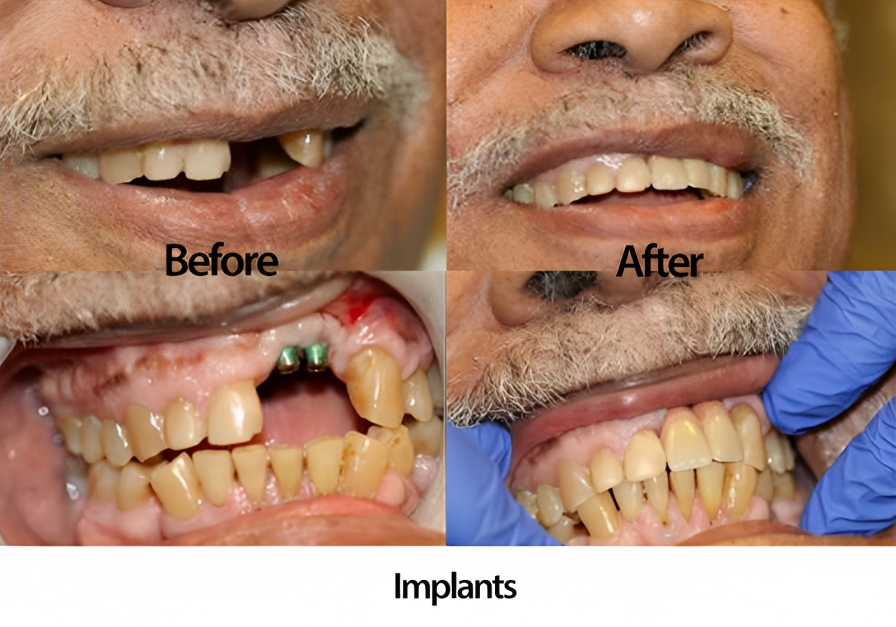 dental implants before and after in Alexandria VA 