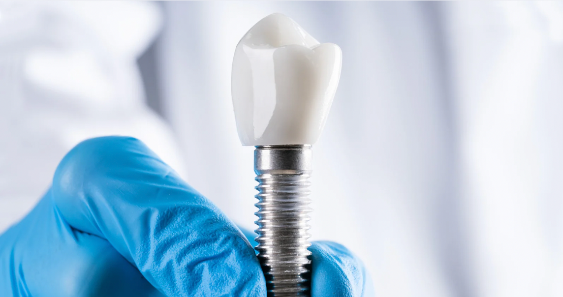 Do Dental Implants Last Forever?