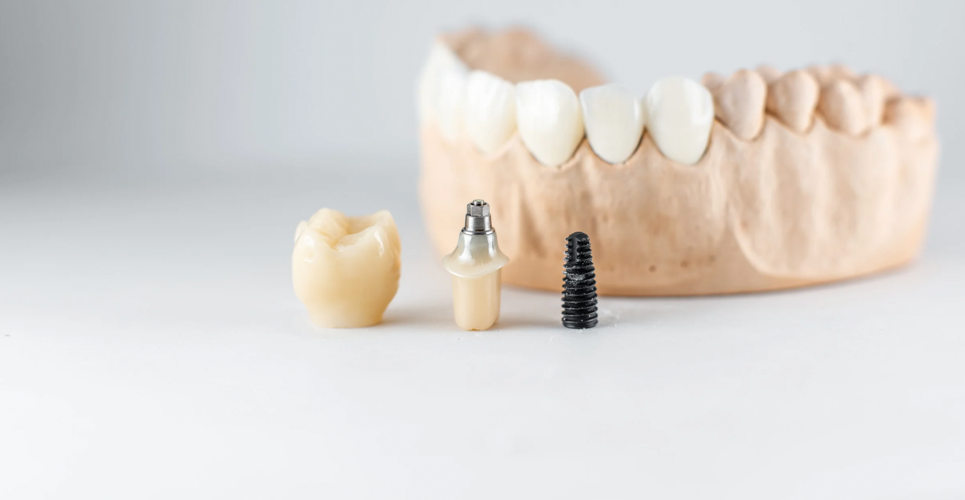 How Long After Dental Implants Can I Eat Normally?