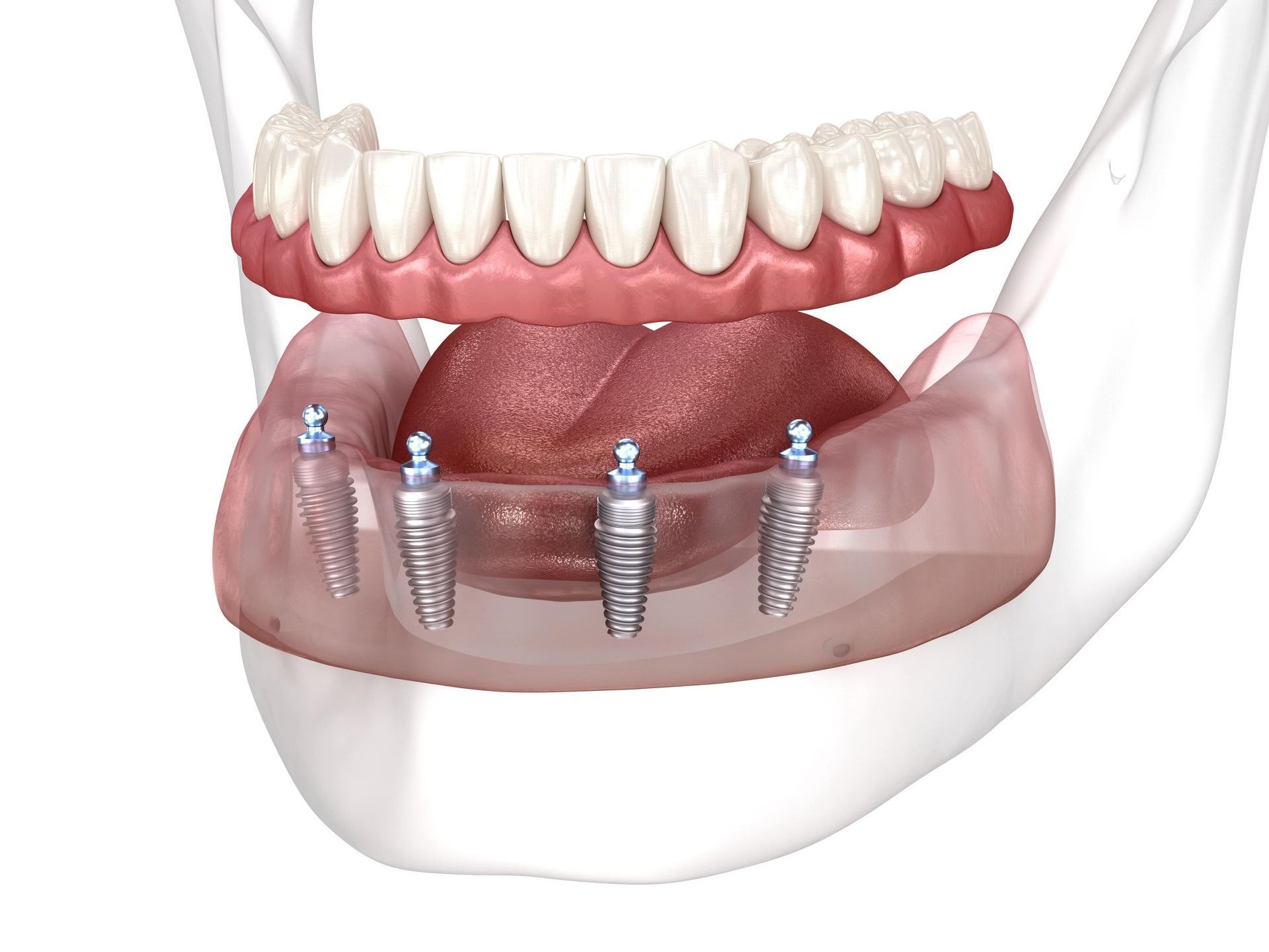 A computer generated image of a full arch all-on-4 implant